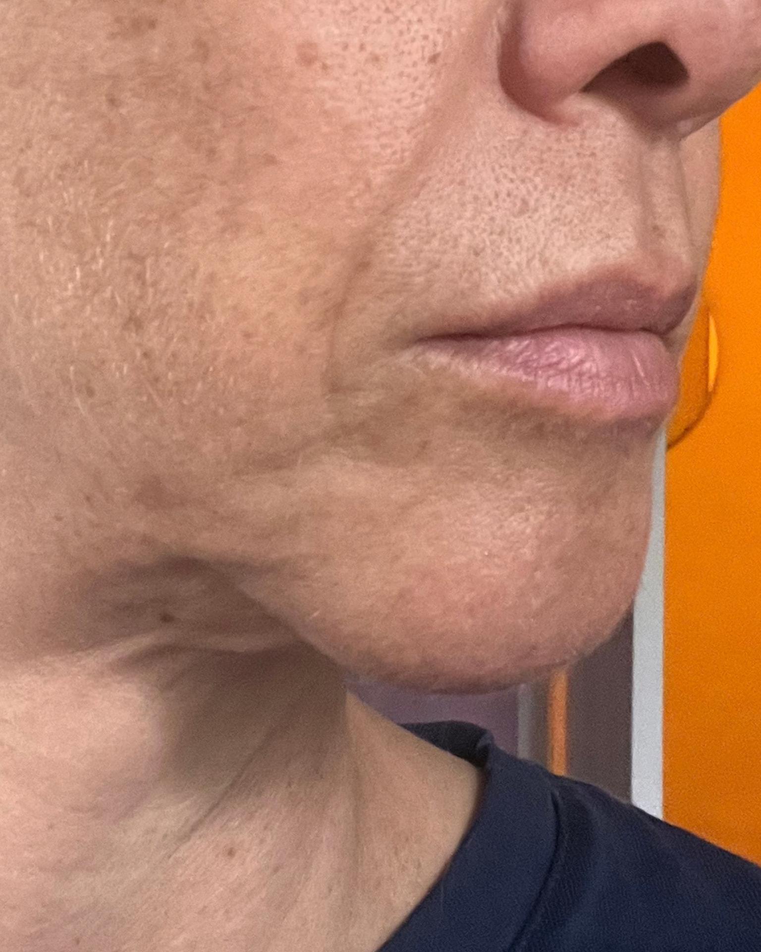 Bothered by Jowls and Nasolabial Folds, Concerned About Scars: Deep Plane Facelift Before and After at 55: Problem · Before, Deepened folds and a heavier lower face