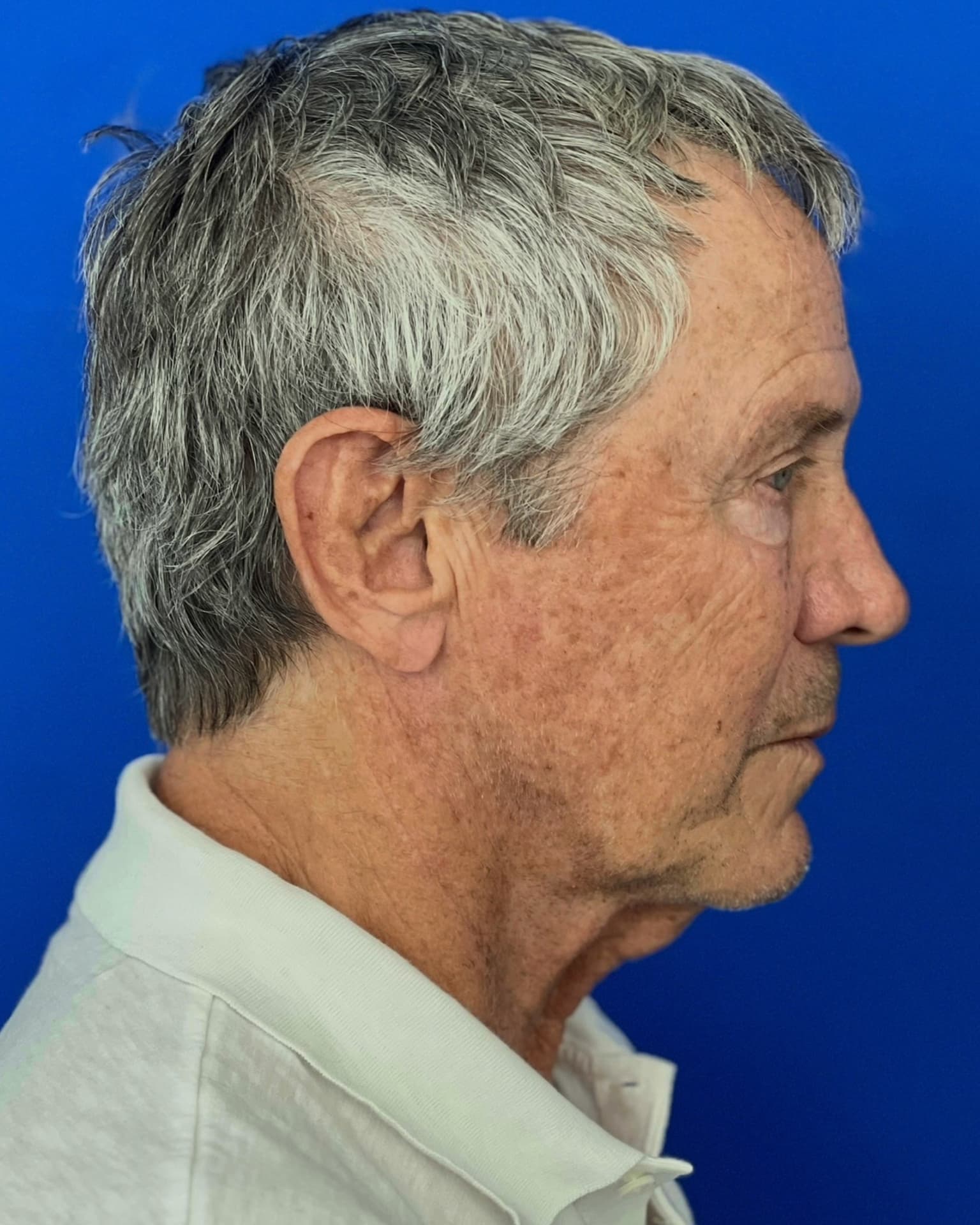 Worried About Keeping His Masculine Look: Natural Male Deep Plane Facelift, Neck Lift, Upper Blepharoplasty & CO₂ Laser Before and After at 72, before, view 5