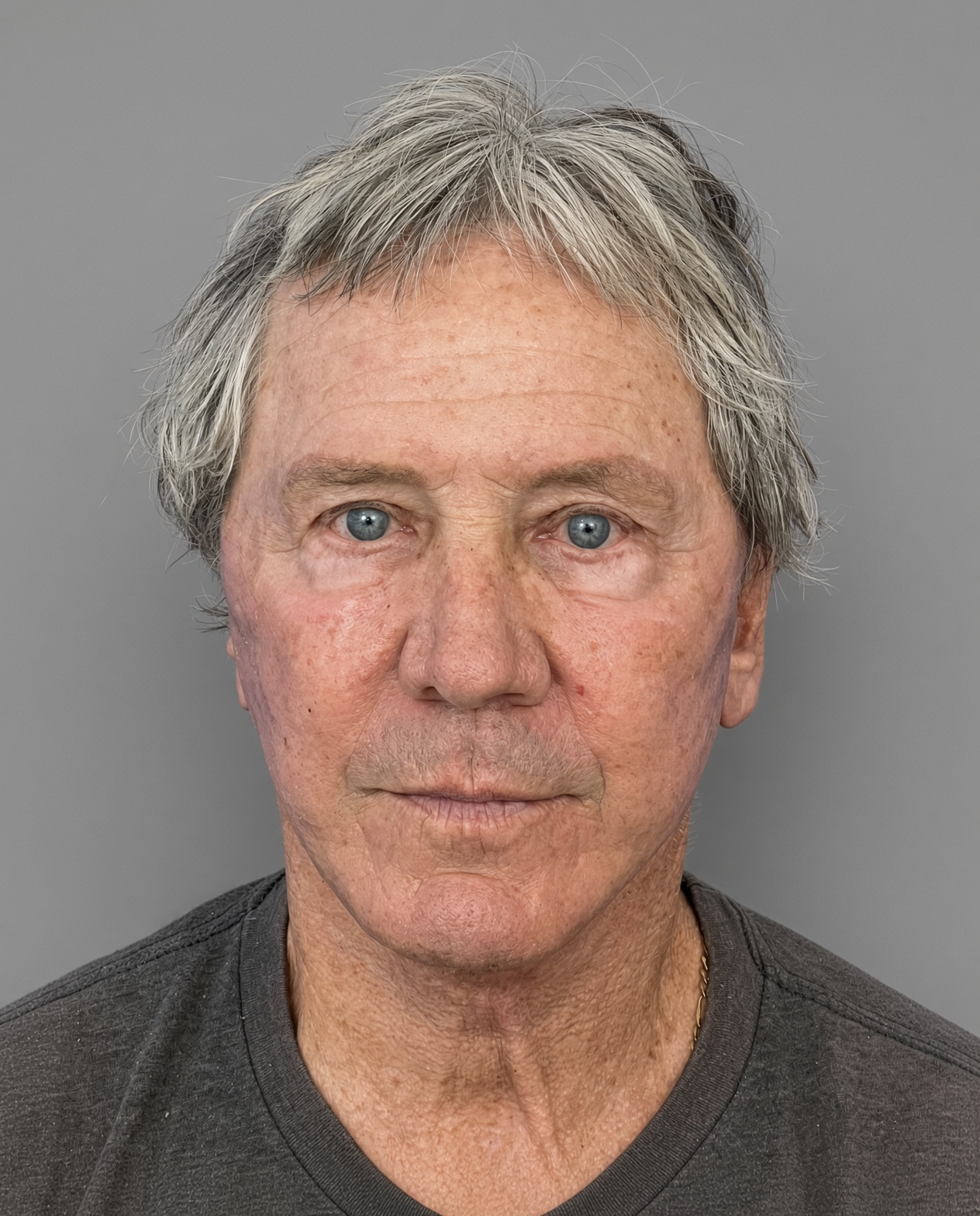 Worried About Keeping His Masculine Look: Natural Male Deep Plane Facelift, Neck Lift, Upper Blepharoplasty & CO₂ Laser Before and After at 73, after, view 1