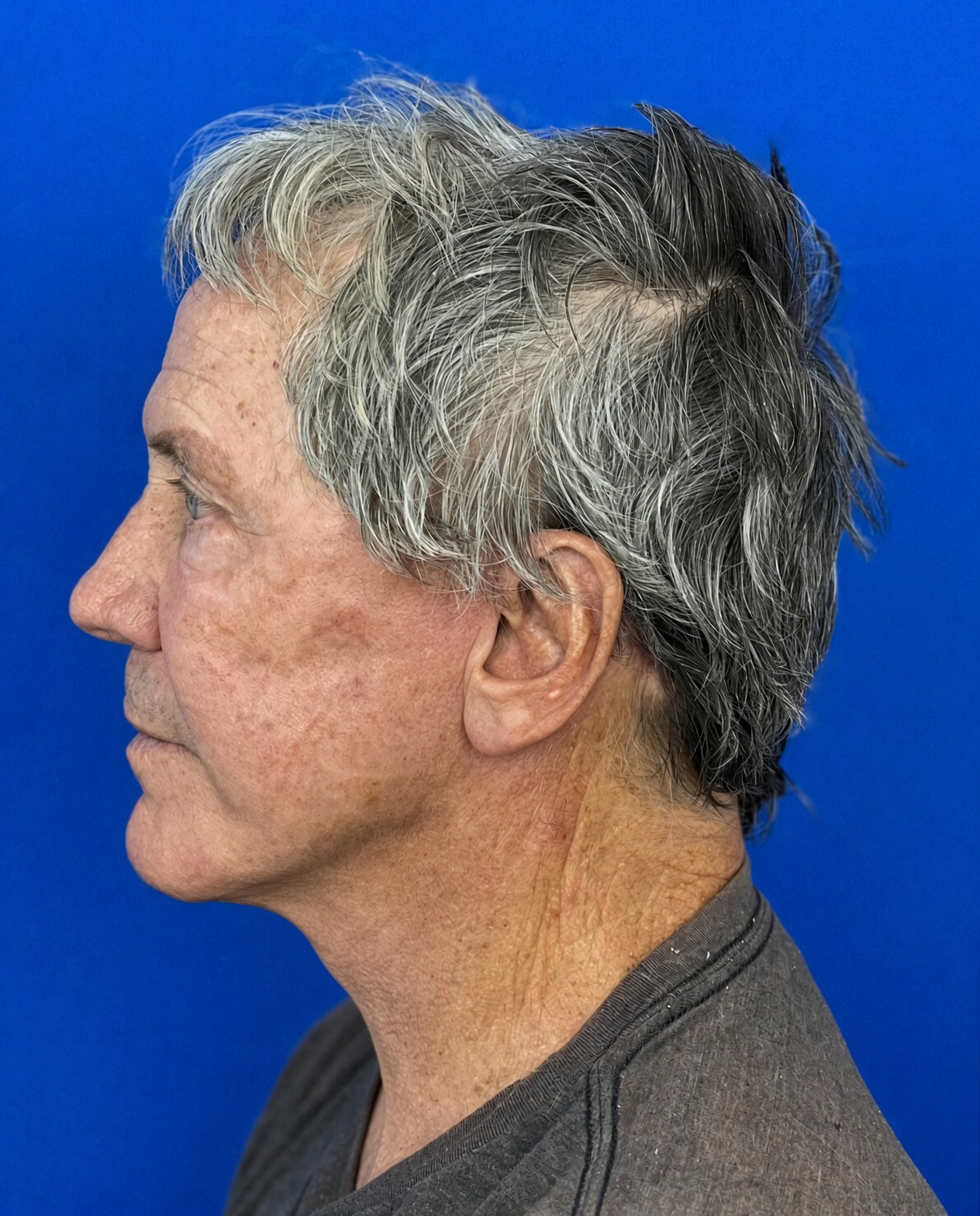 Worried About Keeping His Masculine Look: Natural Male Deep Plane Facelift, Neck Lift, Upper Blepharoplasty & CO₂ Laser Before and After at 72, after, view 3