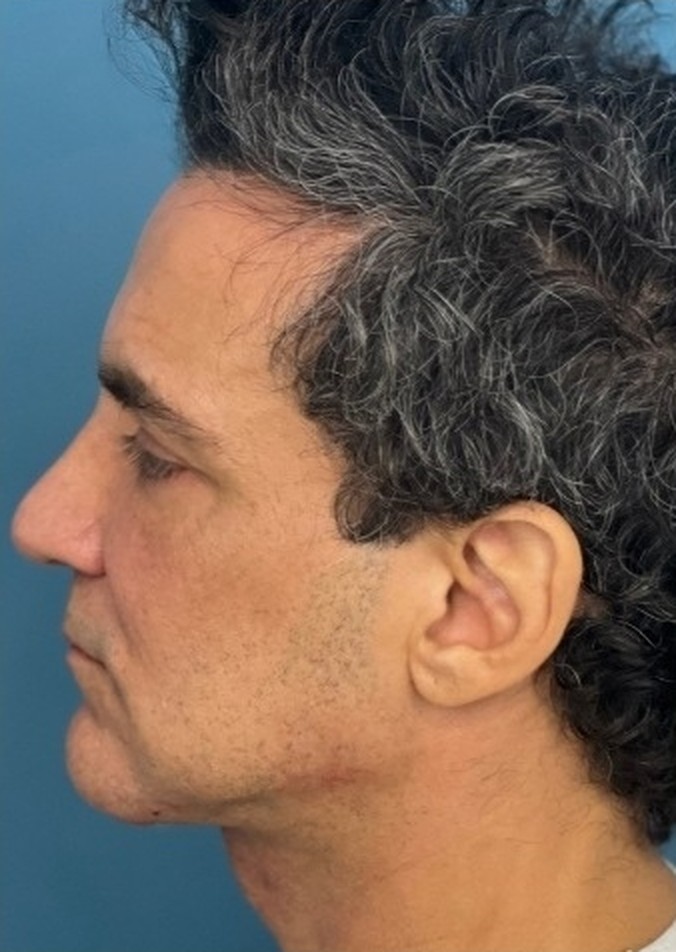 Sharper Jawline, Tighter Neck: Submental Platysmal Plication + Renuvion, Renuvion with platysmal plication, view 2