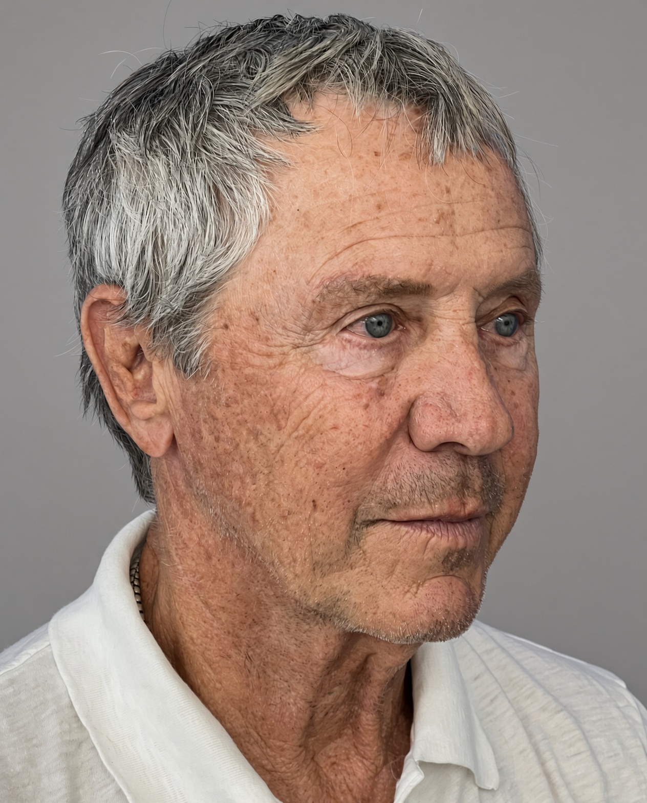 Worried About Keeping His Masculine Look: Natural Male Deep Plane Facelift, Neck Lift, Upper Blepharoplasty & CO₂ Laser Before and After at 73, before, view 4