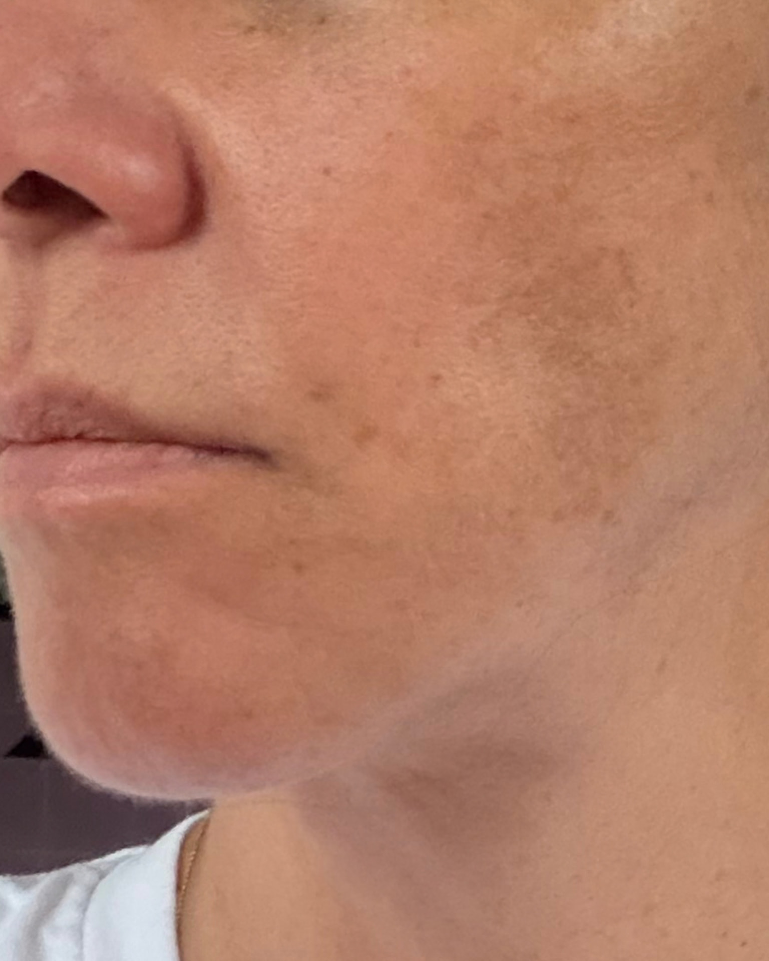 Bothered by Jowls and Nasolabial Folds, Concerned About Scars: Deep Plane Facelift Before and After at 55: Solution · After, Cheek repositioning and jawline definition