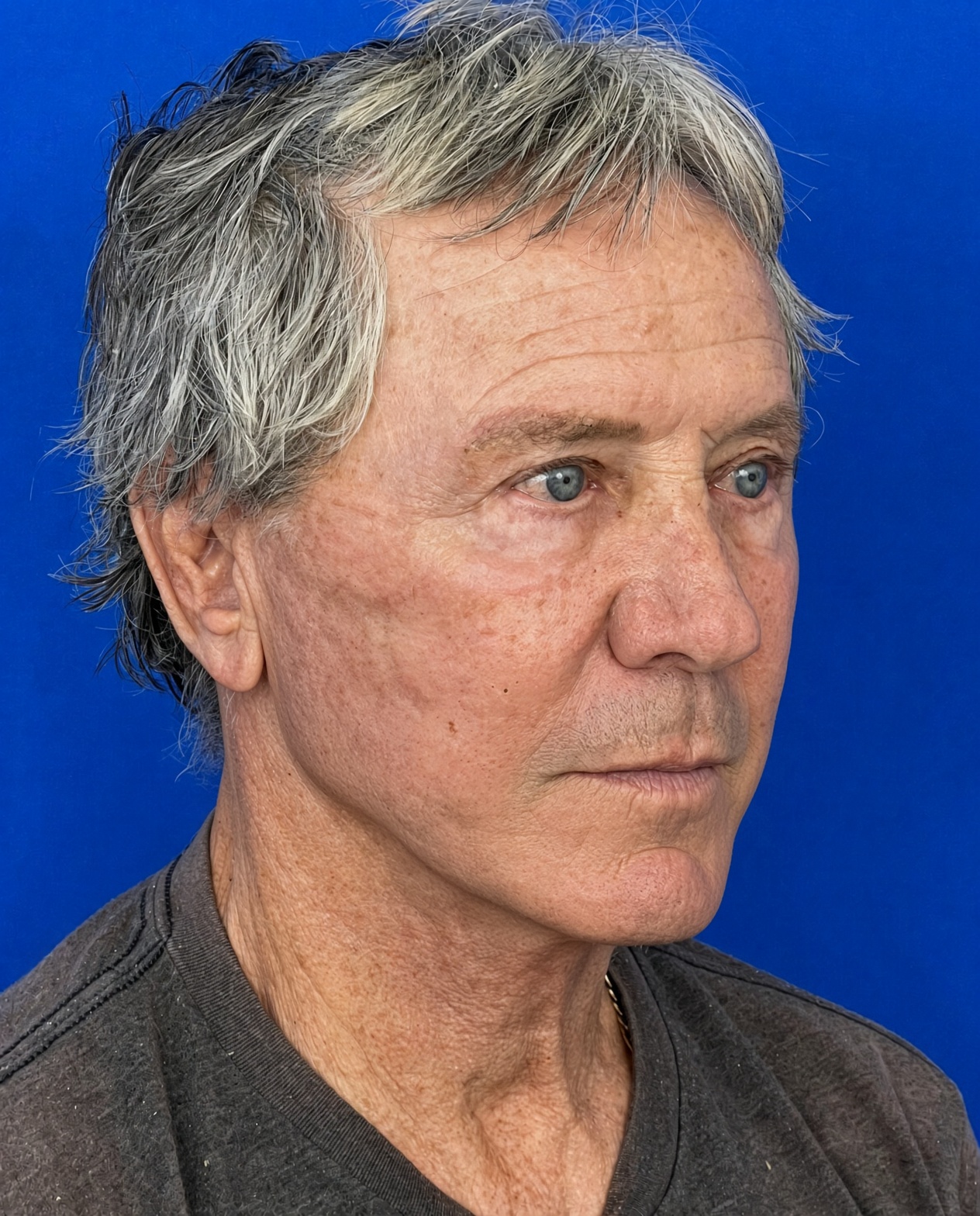 Worried About Keeping His Masculine Look: Natural Male Deep Plane Facelift, Neck Lift, Upper Blepharoplasty & CO₂ Laser Before and After at 72, after, view 4