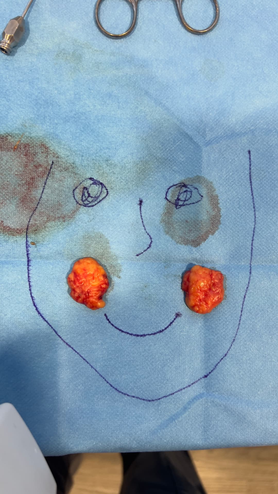Two buccal fat pads removed during office-based buccal fat removal surgery
