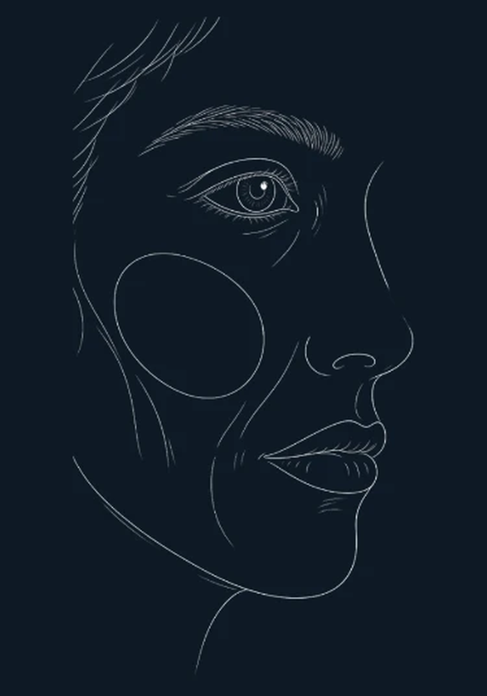 Illustration of cheeks lifted by the END-of-Aging Facelift