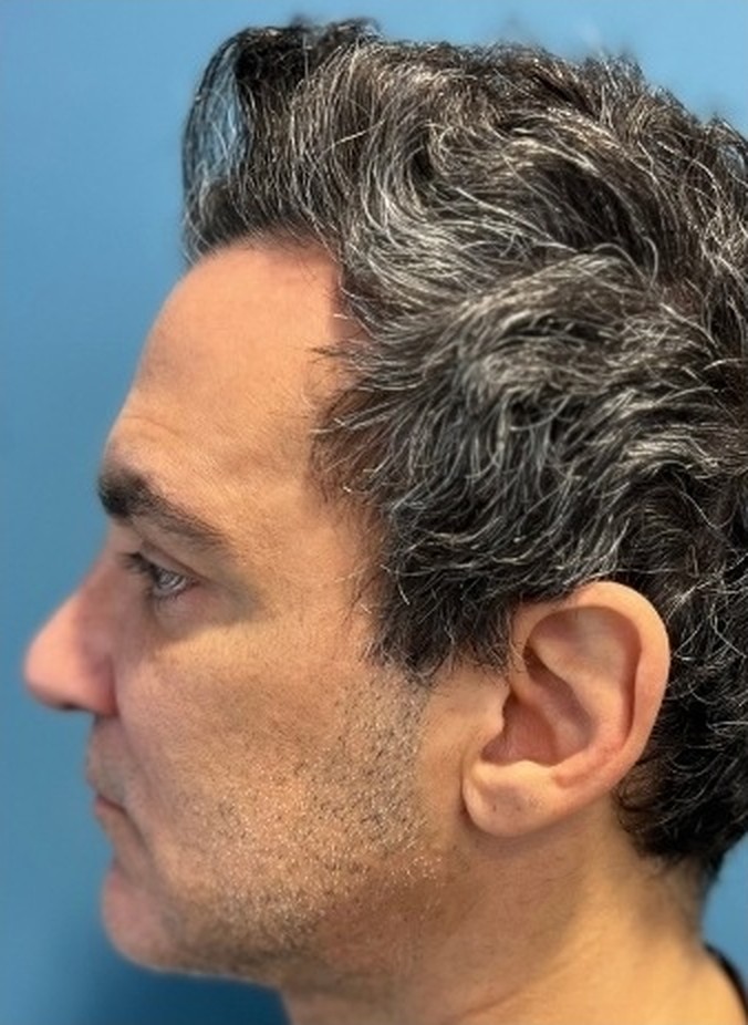 Sharper Jawline, Tighter Neck: Submental Platysmal Plication + Renuvion, Renuvion only — skin tightening without platysmal plication, view 2