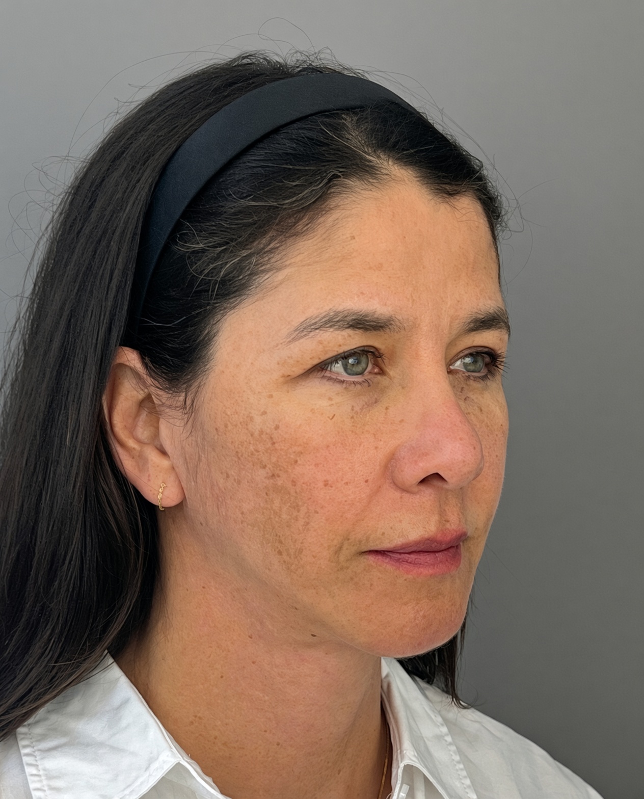 Bothered by Jowls and Nasolabial Folds, Concerned About Scars: Deep Plane Facelift Before and After at 55, after, view 4