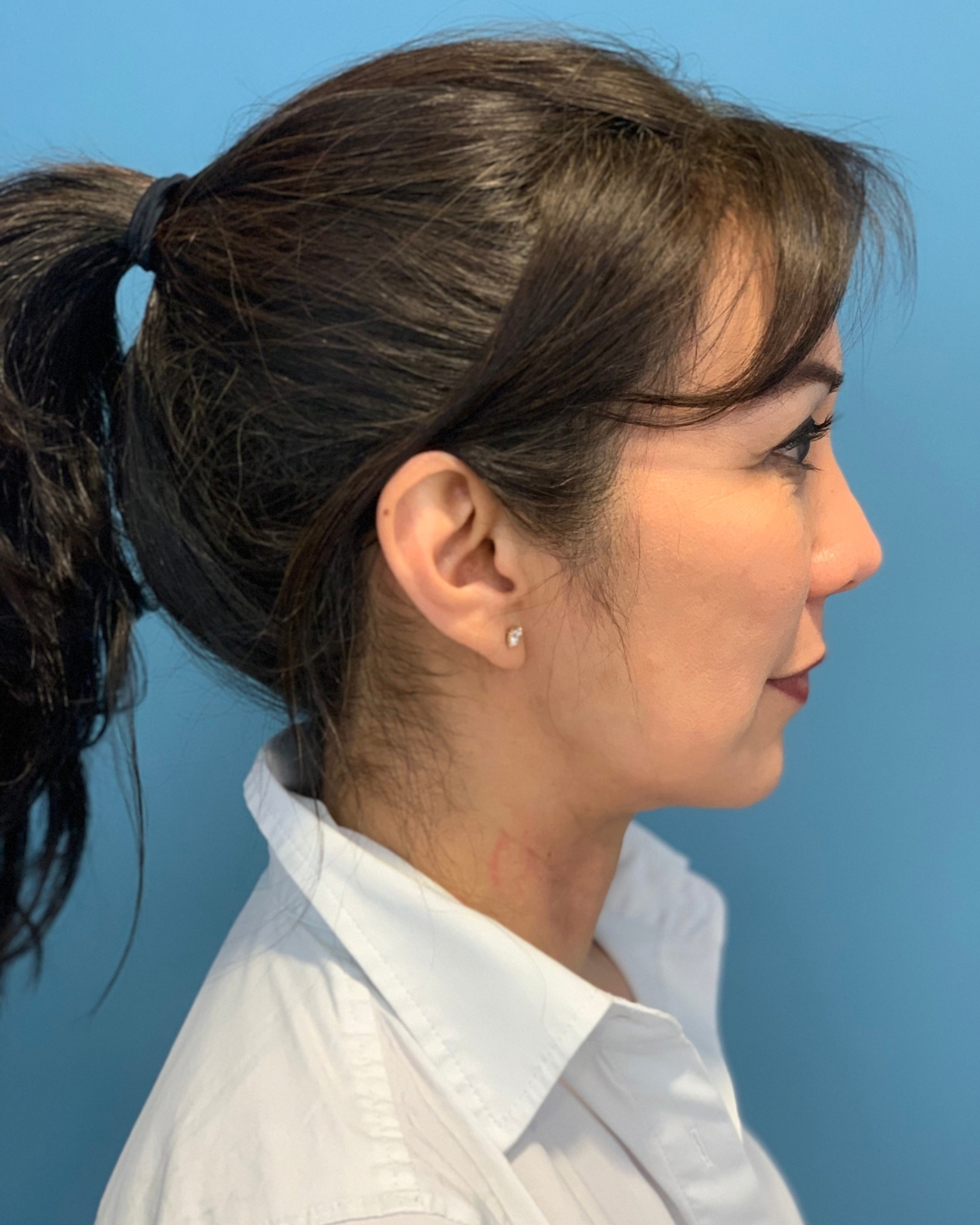 Jawline Contouring Over Time: Submental Platysmal Plication, Then a Lower Facelift and Neck Lift