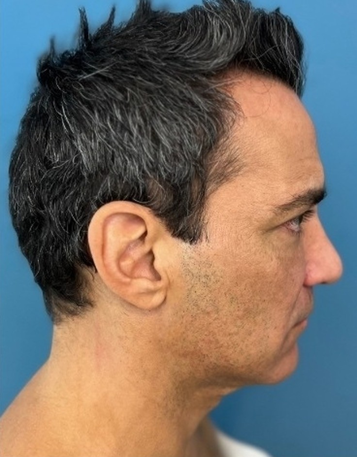 Sharper Jawline, Tighter Neck: Submental Platysmal Plication + Renuvion, Baseline neck and jawline prior to treatment, view 5