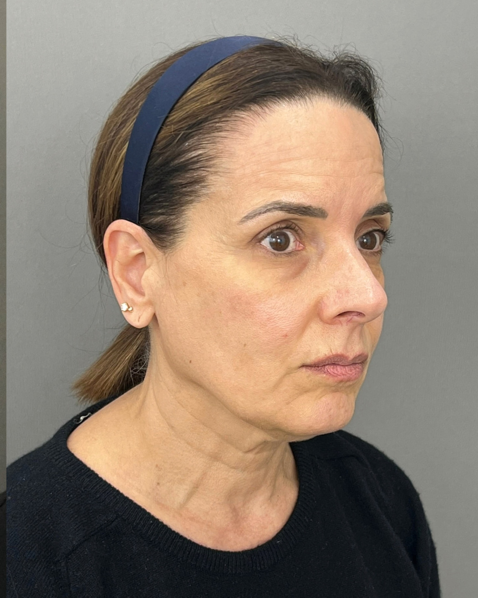 Deep Plane Facelift at 61: Upper, Mid & Lower Lift with Blepharoplasty — Before and After, before, view 4