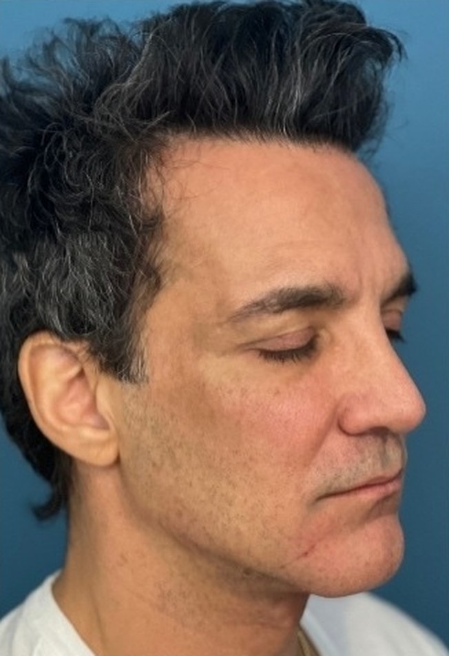 Sharper Jawline, Tighter Neck: Submental Platysmal Plication + Renuvion, Renuvion with platysmal plication, view 4