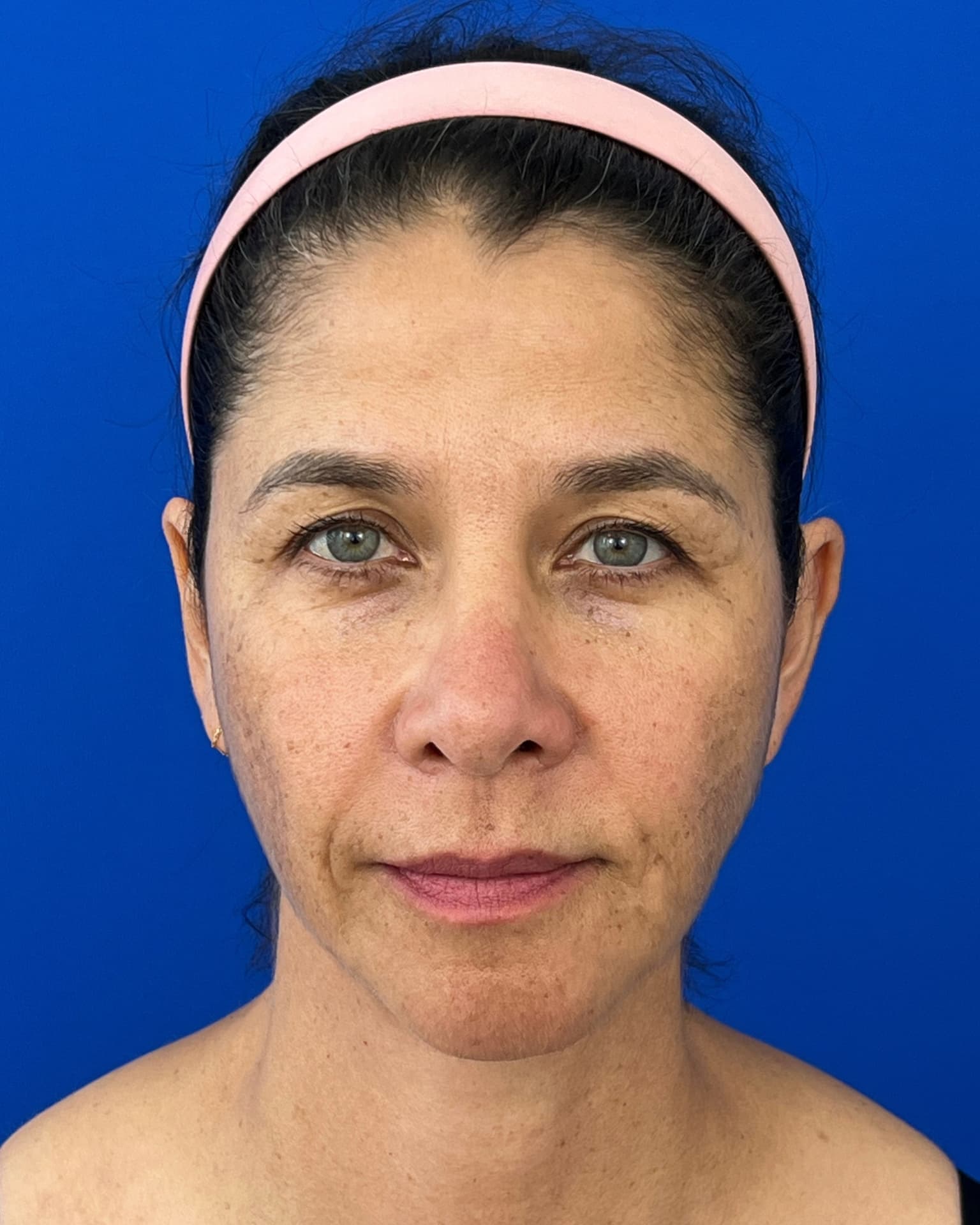 Bothered by Jowls and Nasolabial Folds, Concerned About Scars: Deep Plane Facelift Before and After at 55, before, view 1