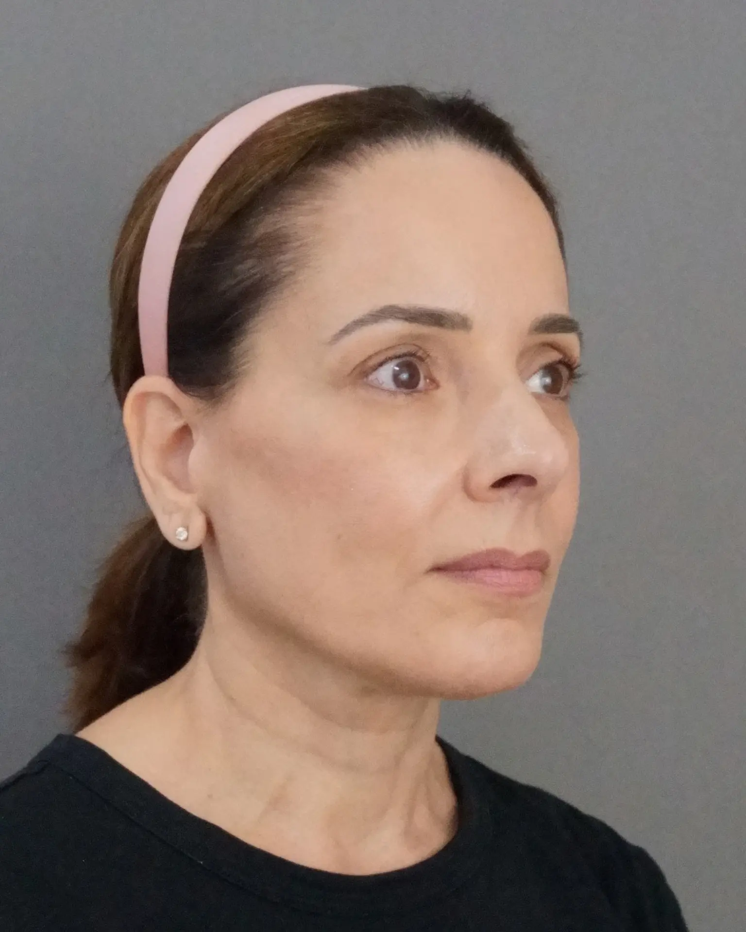 Deep Plane Facelift at 61: Upper, Mid & Lower Lift with Blepharoplasty — Before and After, after, view 4