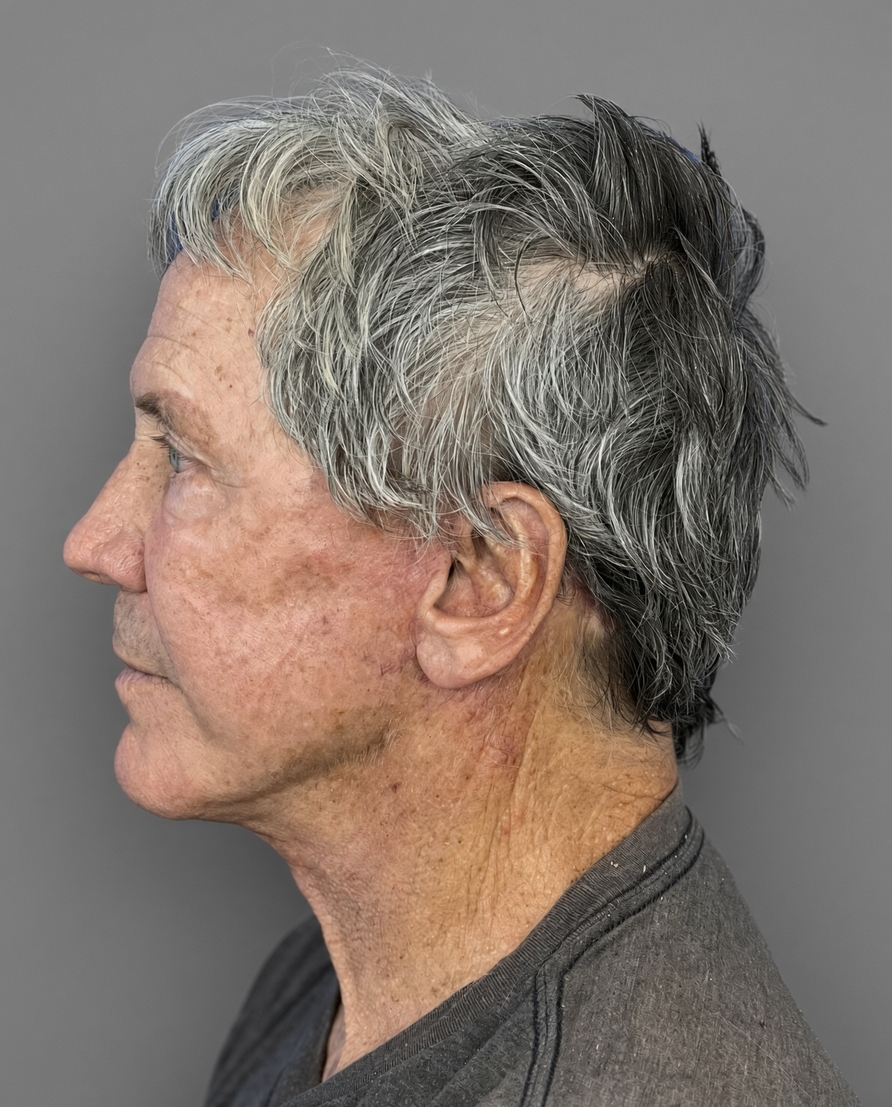 Worried About Keeping His Masculine Look: Natural Male Deep Plane Facelift, Neck Lift, Upper Blepharoplasty & CO₂ Laser Before and After at 73, after, view 3