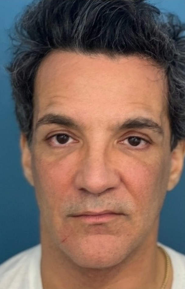 Sharper Jawline, Tighter Neck: Submental Platysmal Plication + Renuvion, Renuvion with platysmal plication, view 1