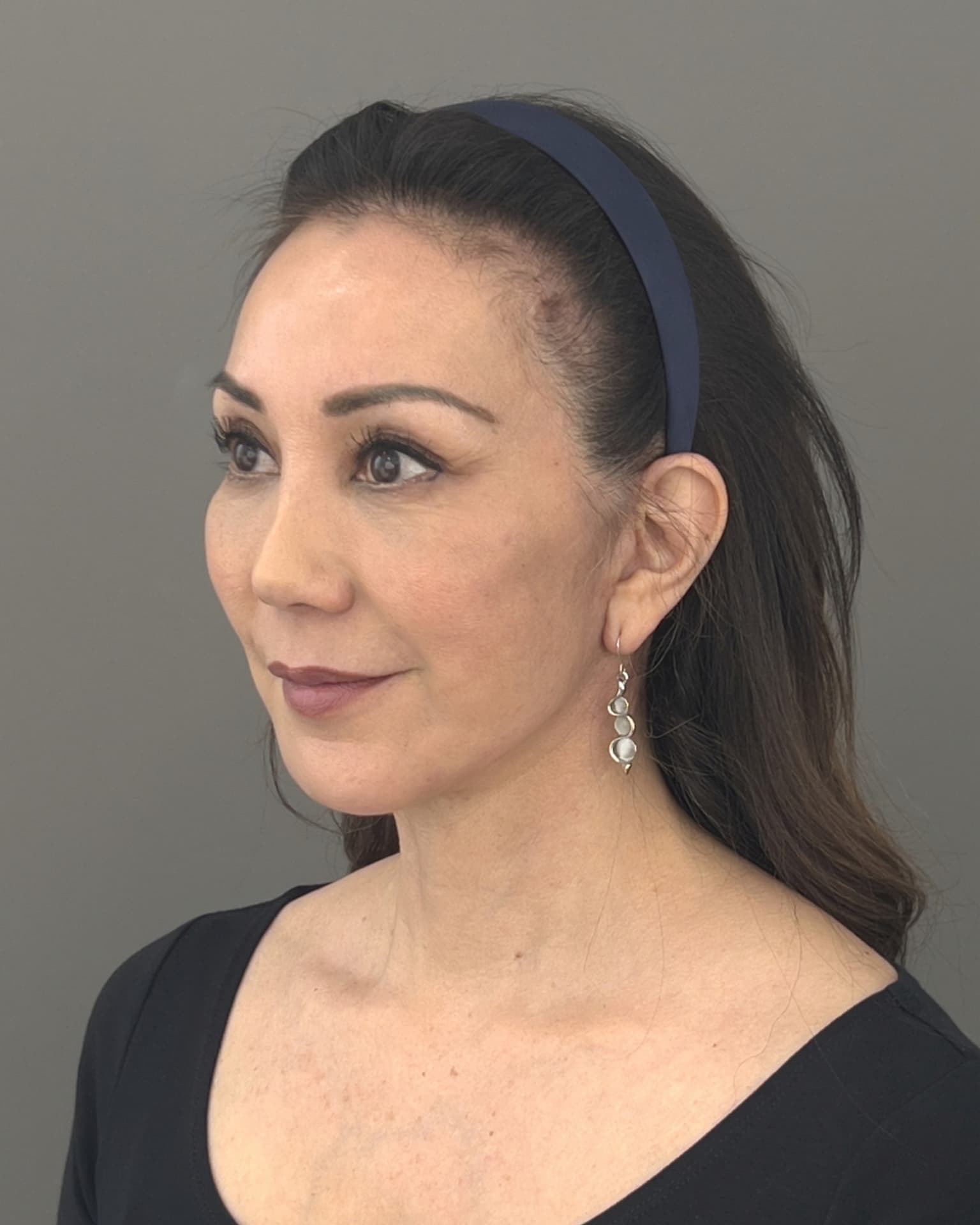 Facelift and Neck Lift at 60: Why Dr. Trott Started With the Neck, after, view 2