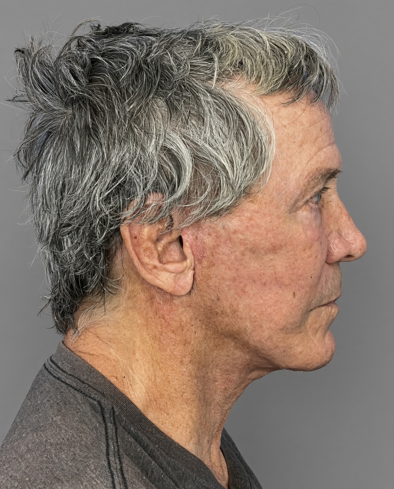 Worried About Keeping His Masculine Look: Natural Male Deep Plane Facelift, Neck Lift, Upper Blepharoplasty & CO₂ Laser Before and After at 73, after, view 5