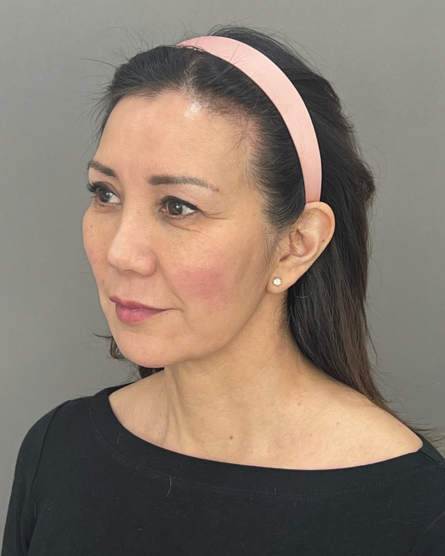 Facelift and Neck Lift at 60: Why Dr. Trott Started With the Neck, before, view 2