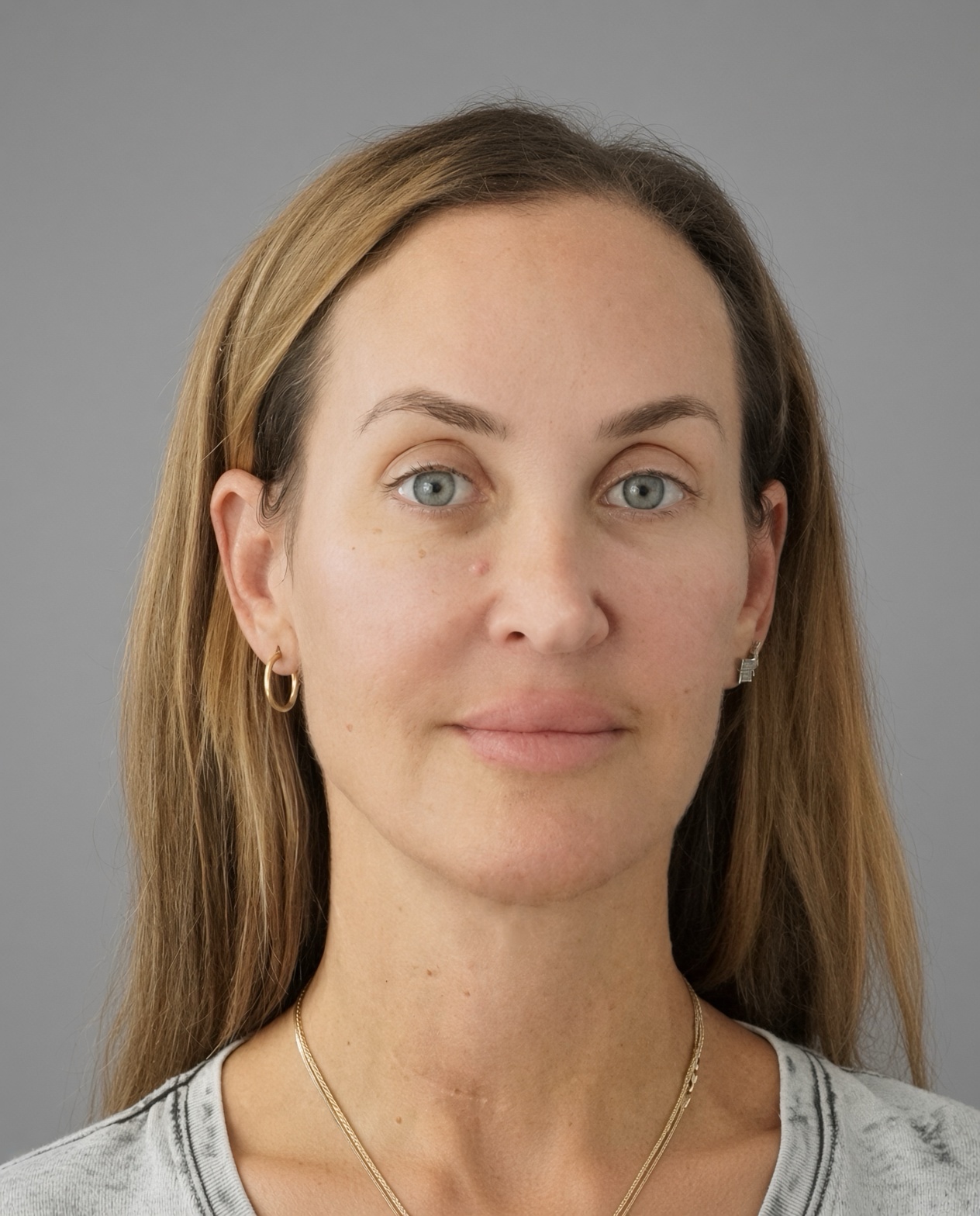 50 Year Old END of Aging Facelift by Dr. Suzanne Trott: Endoscopic Deep Plane Results at 3 Months, after, view 1