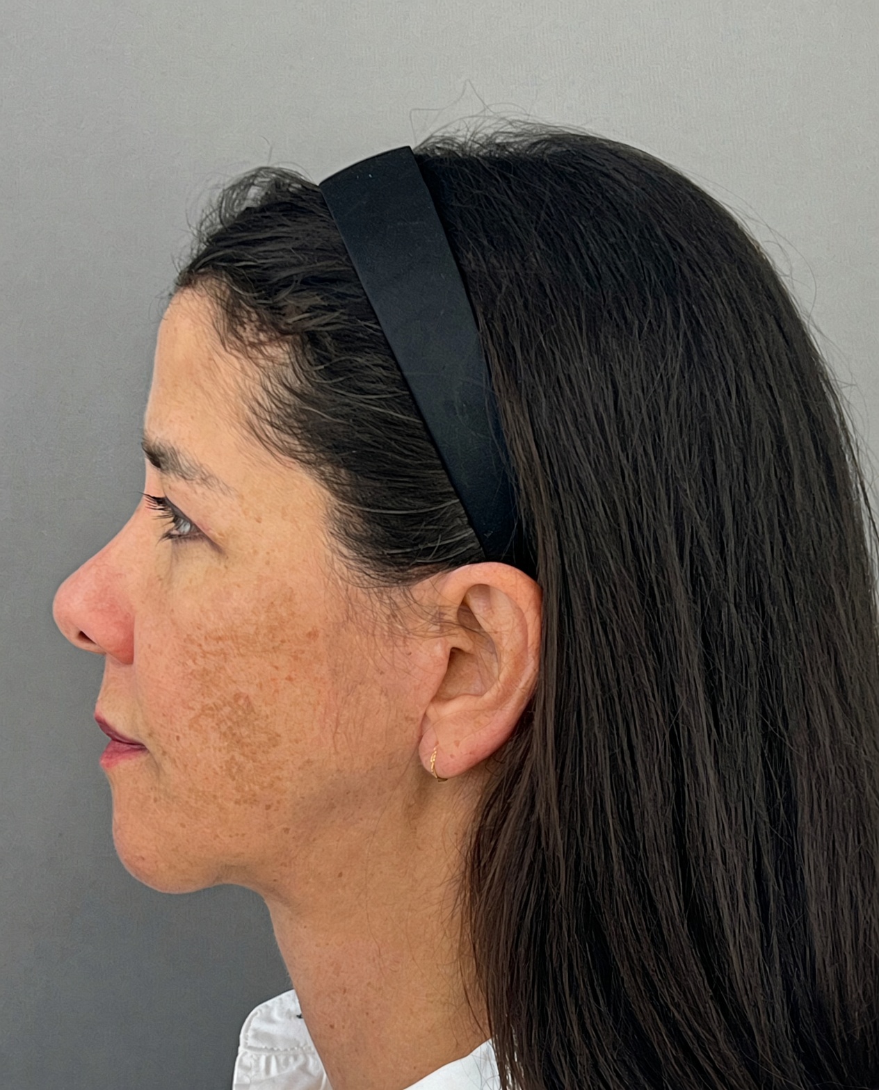 Bothered by Jowls and Nasolabial Folds, Concerned About Scars: Deep Plane Facelift Before and After at 55, after, view 3