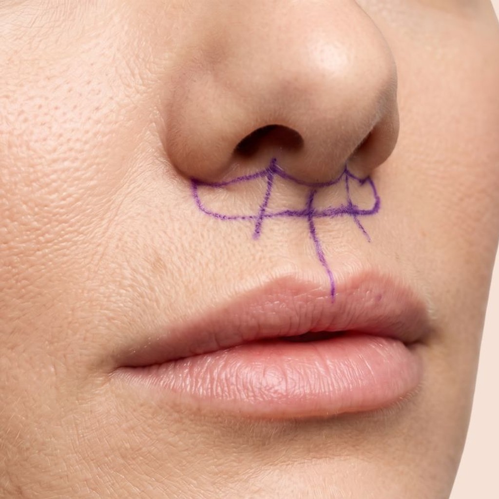 Lip Lift in Beverly Hills, CA